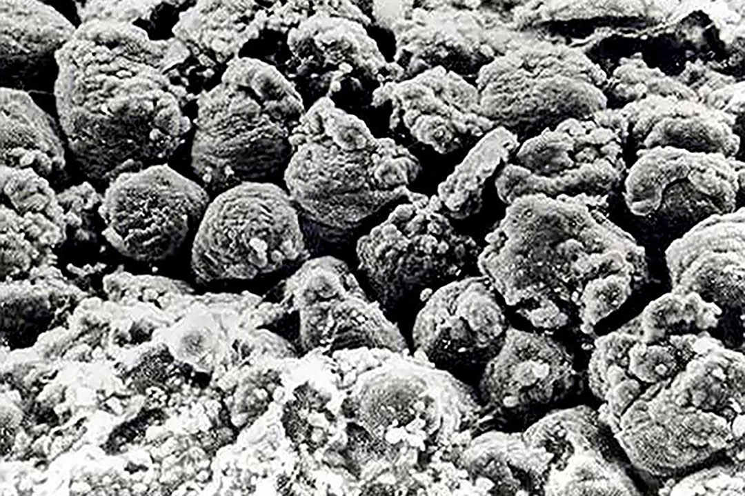 Künt uçlu villus, villus füzyonu, lümende birikinti ve bağırsak hücreleri arasında daha fazla boşluk gösteren sızdıran bağırsak.  Fotoğraf: “Impextraco”